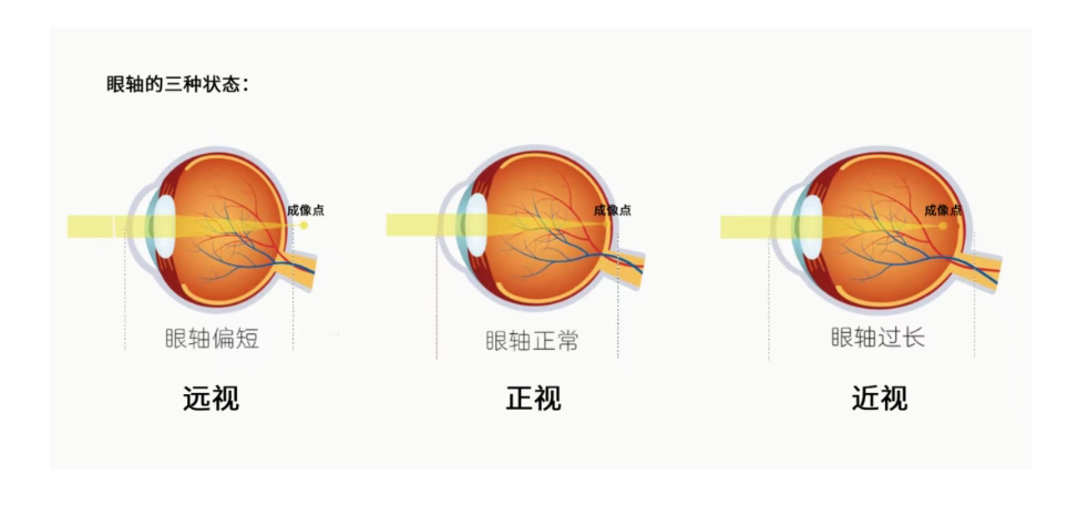 有家长发来咨询，说学校体检发现孩子远视储备不足，到底是怎么回事？